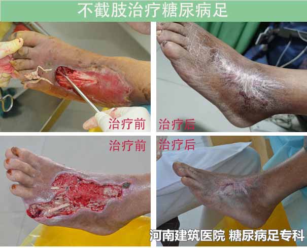 糖尿病并发症烂脚截肢还能活多久?