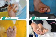 糖尿病足烂脚使用消炎药应该注意什么？