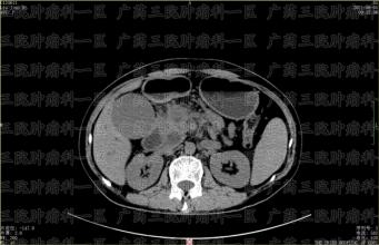 重视胰腺癌的早期诊断