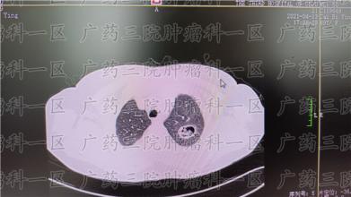 我不吸烟，为什么也会得肺癌？
