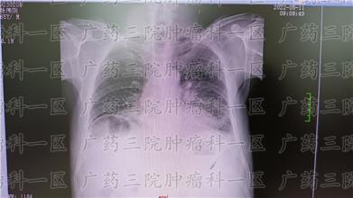 为什么从来不吸烟也会得肺癌？