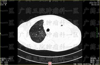 肺癌的常见致病因素