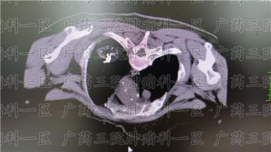 专家提出：如何识别早期肺癌