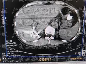 多年前父亲因癌去世，多年后儿子竟同样患癌
