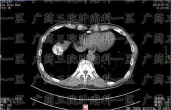 丙肝是怎么感染的？专家说，不要放弃，丙肝