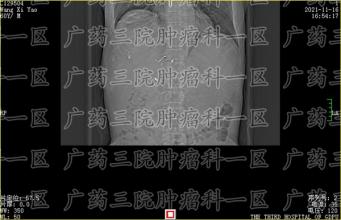 实在肝癌发生之前，身体就有提醒