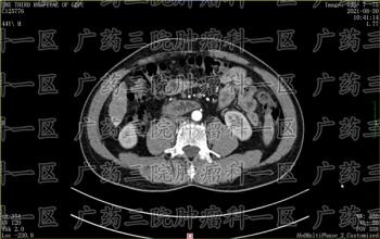 从肝炎到肝癌，身体给了3次机会，别不当回