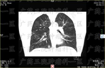 肺癌由于肺部的“特殊性”，很难在早期发现