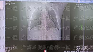 遭遇肺癌，先问医生这8个问题