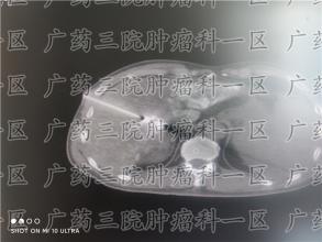 肺部恶性肿瘤早期，早发现能保命