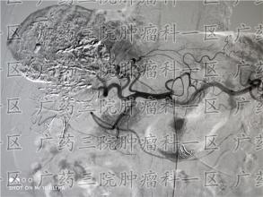 东莞塘厦治疗胃癌的医院哪里好