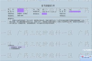 横纹肌肉瘤是什么病?