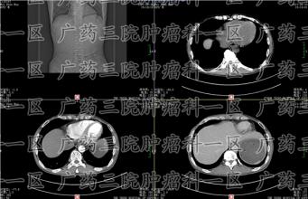 癌症术后化疗真的有用吗？