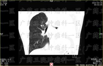 广药三院|靶向治疗出现耐药现象，放化疗又