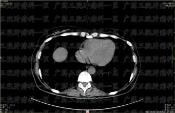 80%以上的原发性肝癌发生在肝硬化的基础