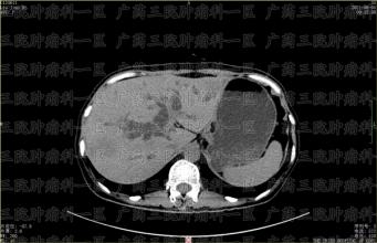 为何靶向治疗会产生耐药性？如何尽可能降低