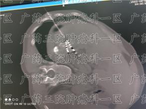从子宫内膜癌到宫颈癌，仅用了一年时间