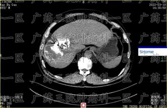 癌症晚期，疼痛成为最普遍的现象