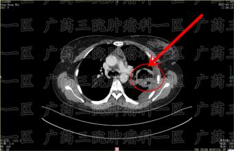 天气炎热，癌症病人要掌握以下康复知识，不