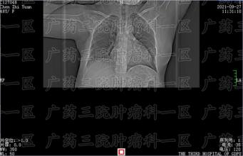 癌症一旦发展到晚期，弄清这些事，与疾病走