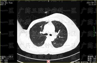 癌症的早中晚期如何区分？不同阶段对应的方