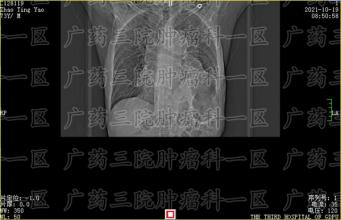 化疗扛不住，不想再继续了，该怎么办？