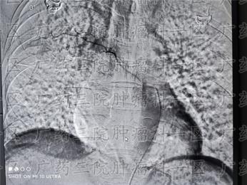 这样的咳嗽，要警惕肺癌。