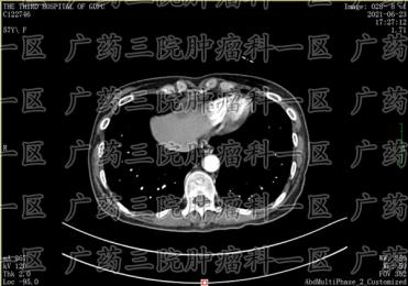 宫颈鳞状细胞癌的微创治疗，广药三院肿瘤科