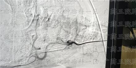 癌痛不止，选好镇痛方案是关键