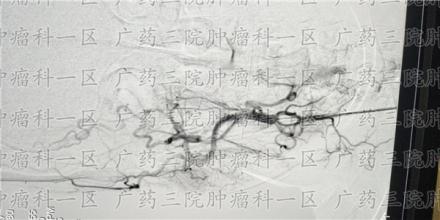 食道肿瘤能治好吗？手术成功率是多少？