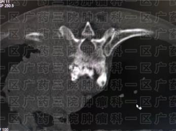 癌症肱骨转移粒子治疗，止痛又治癌