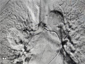 肺癌精准微创结合靶向治疗
