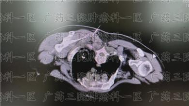 癌痛难忍？还有哪些止痛药可以止痛？