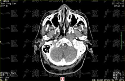 高度怀疑鼻咽癌要怎么办？广药三院肿瘤科一