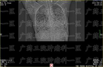 癌症患者如何提高免疫力？
