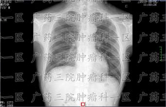 胆管癌，始于胆管
