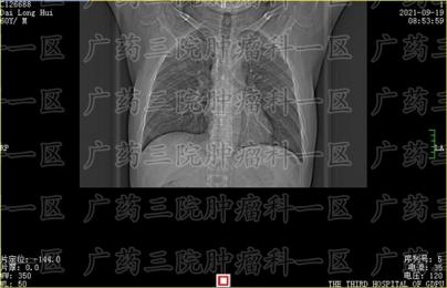 清远好鼻咽肿瘤微创治疗医院