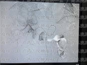 广药三院肿瘤科一区：胆管会有癌吗？严重吗