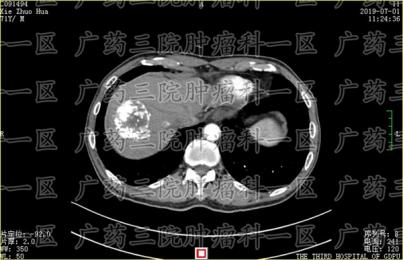 肇庆肿瘤医院治疗肝肿瘤专业吗