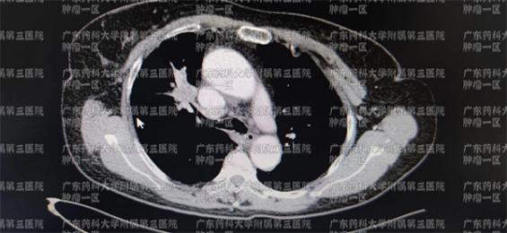不明原因头痛，小心肺癌脑转移