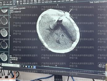 肺癌脑转移有什么症状和体征