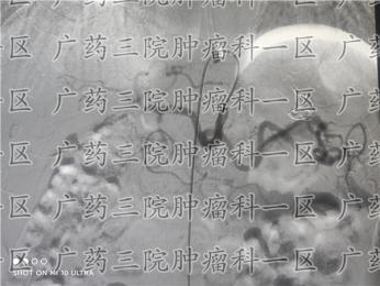 广药三院肿瘤科：胃癌肝转移淋巴转移，治疗