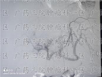 甲胎蛋白多少可能是肝癌广东药科大学广州复