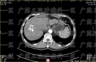 #肝癌术后多久进行一次影像学复查#广药三