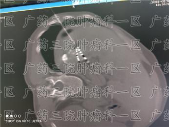广东药科大学广州复星禅诚医院,肿瘤科一区