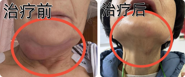 牙龈癌淋巴转移剧痛难忍，一程抗癌治疗后患