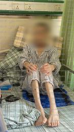 广东广州高龄胃癌患者如何治疗